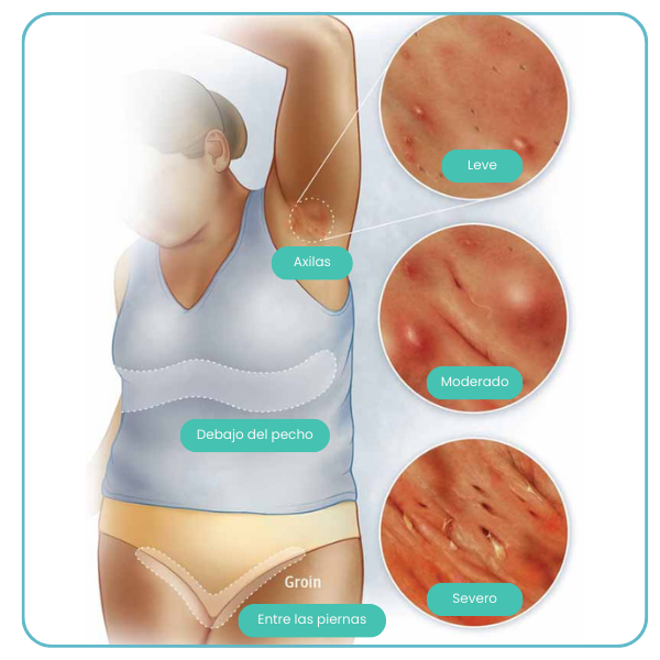 Landing Hidradenitis Supurativa 2025